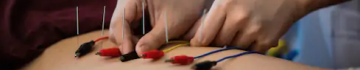 Electroacupunctura